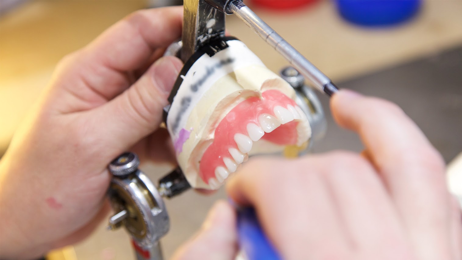 prothèses sur implants